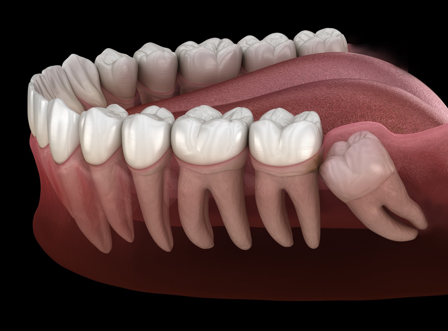 Https://Assets.Tina.Io/14718b50 C6d7 4203 99ac C8bb60660f67/Images/Services/Wisdom Tooth Extraction/Wisdom Tooth Mold.Jpg