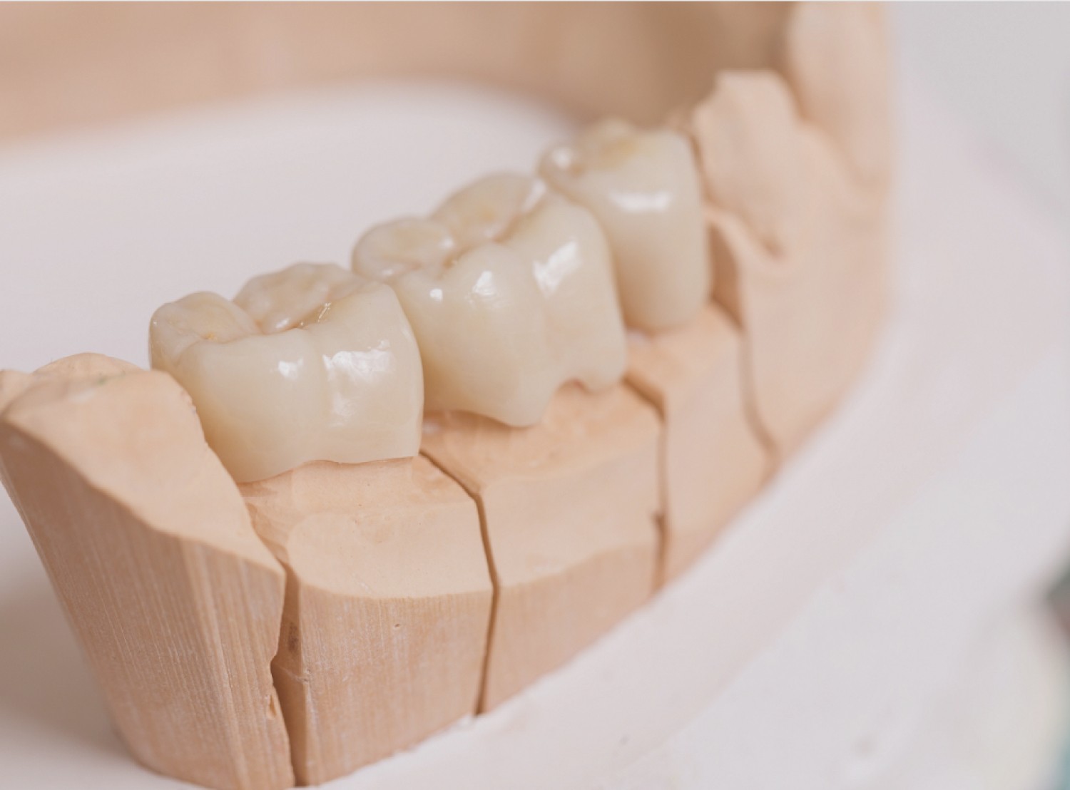 Https://Assets.Tina.Io/14718b50 C6d7 4203 99ac C8bb60660f67/Images/Services/Dental Bridges/Dental Mold.Jpeg