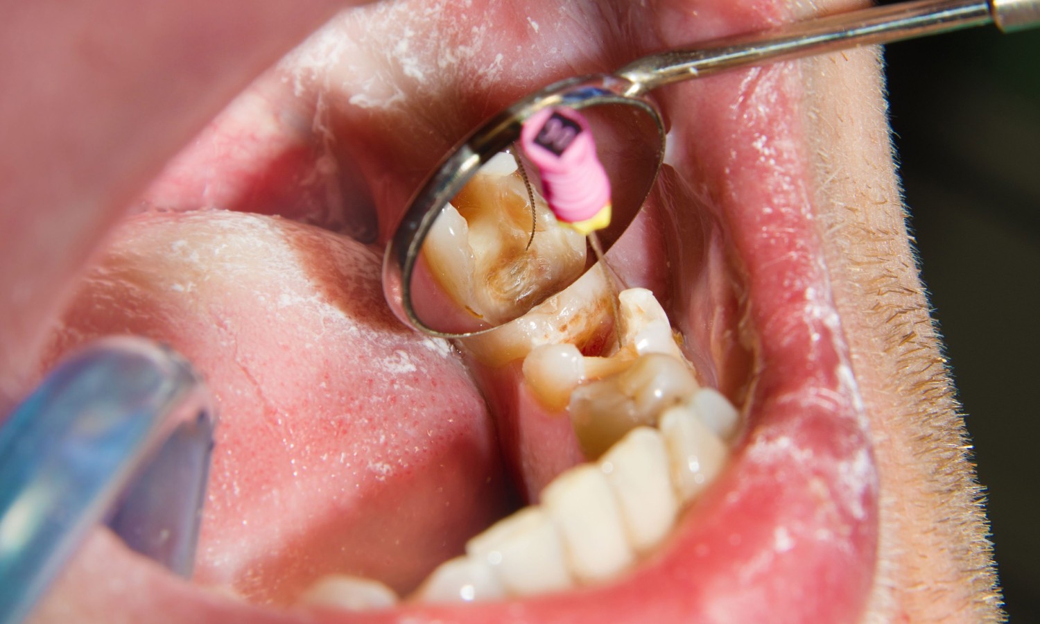 dental molds lined up on a table